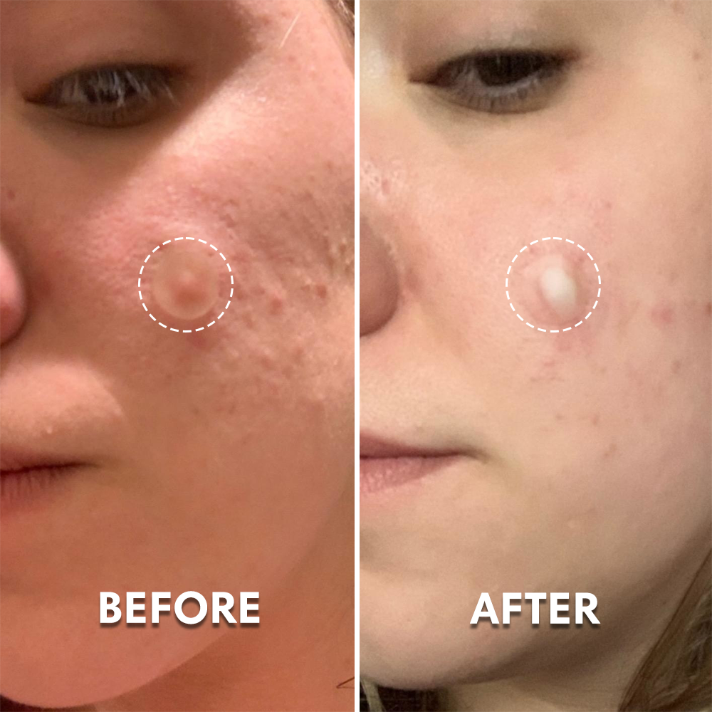 Pimple Patches With Hydrocolloid