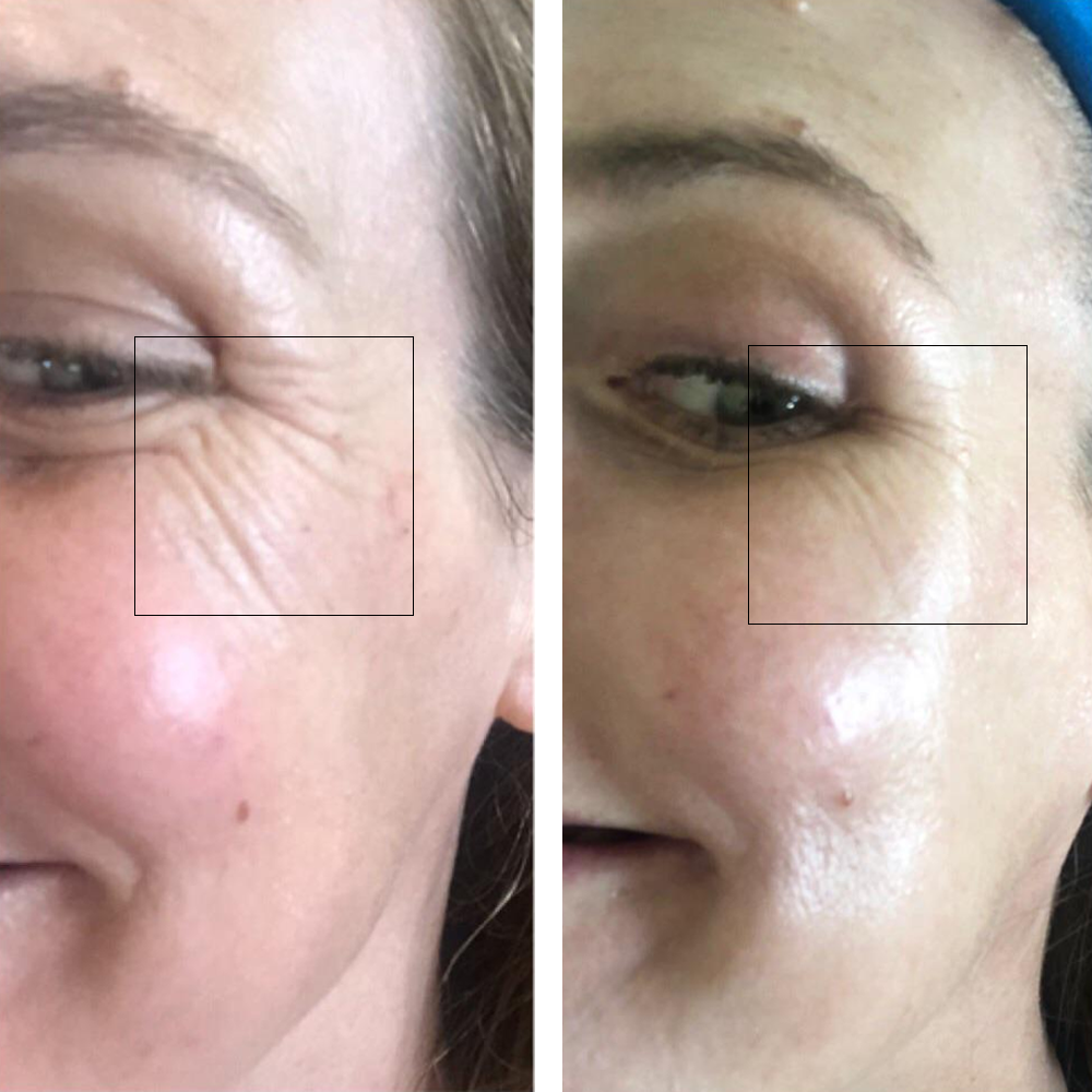 Before and after comparison showing the appearance of the eye area