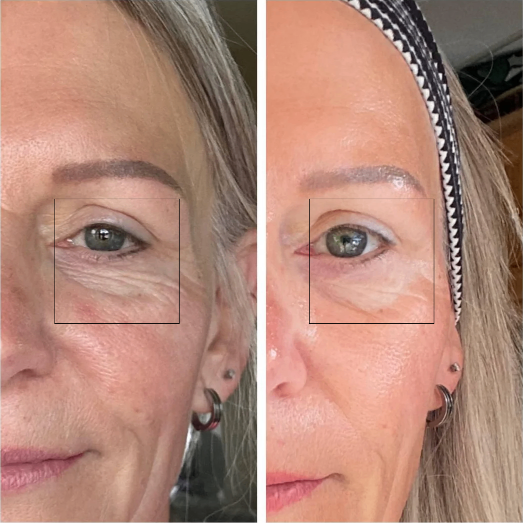 Side-by-side comparison of a woman's face with and without a cosmetic treatment on her eye area.